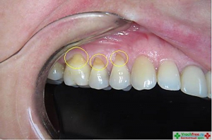 Главная причина клиновидного дефекта зубов - нарушение прикуса