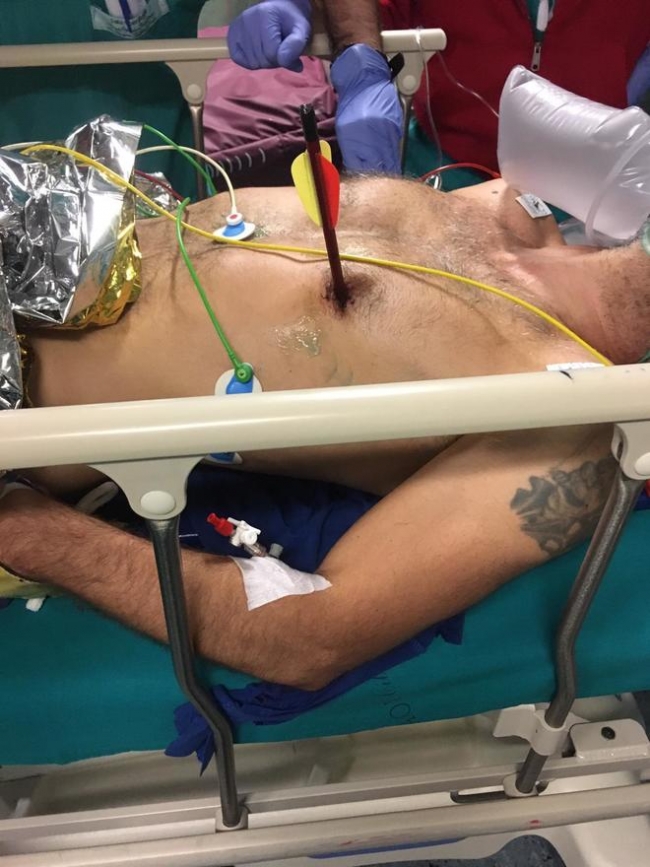 В Италии спасли мужчину, которому в сердце попала арбалетная стрела