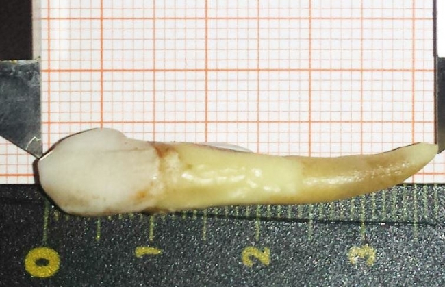Немецкий дантист опубликовал фото самого длинного зуба, который попал в Книгу рекордов Гиннеса