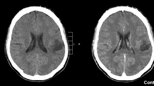 Новый метод лечения останавливает рост опухоли мозга в 60% случаев