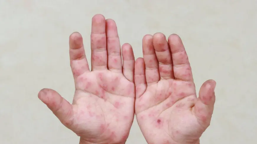 Обережно! В Румунії кір!