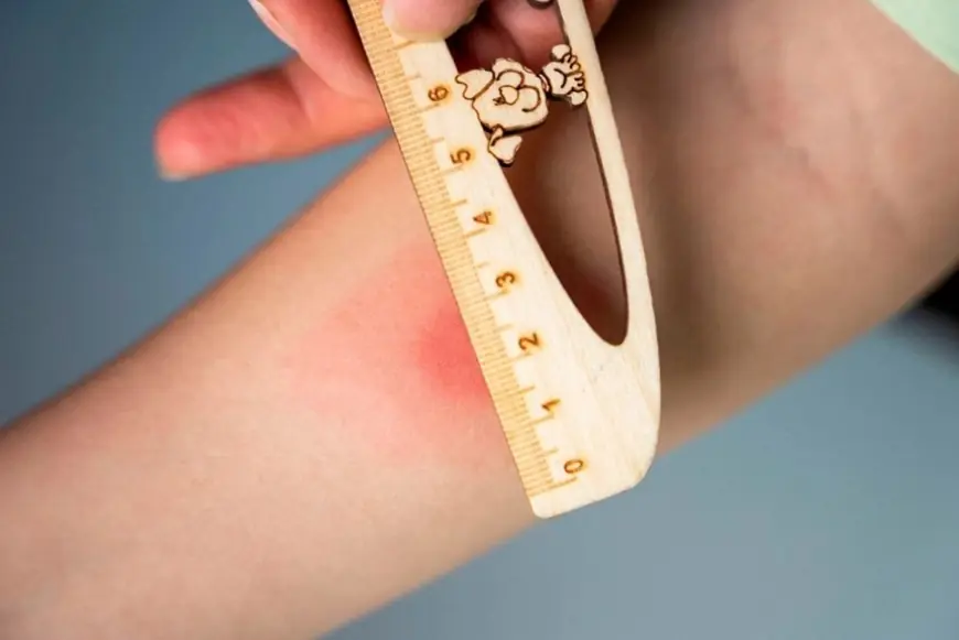 В Україні замінюють пробу Манту на сучасний тест на туберкульоз